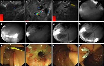 Treatment of obstructive jaundice induced by non-hodgkin lymphoma with EUS-guided transgastric anterograde common bile duct stenting: Technical case report and literature review